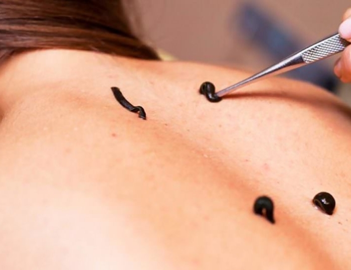 Гирудотерапия - Санаторий «Долина Нарзанов» РЖД-Здоровье Железноводск